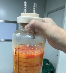 平顶山水动力吸脂手术要做多久？